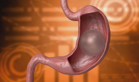Trying to Make Sense of Gastric Balloon Costs (Without Getting Overwhelmed)